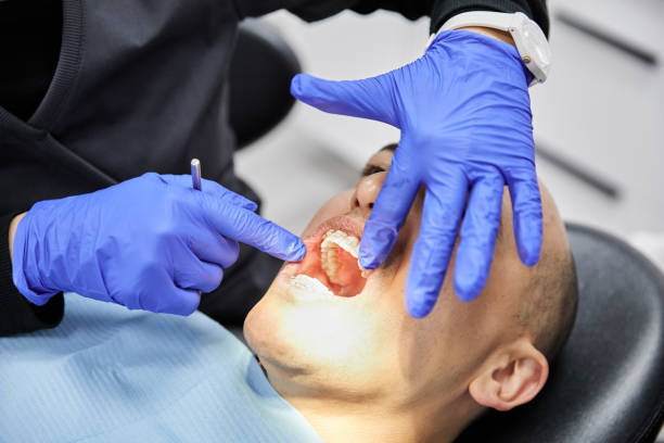 Best Emergency Wisdom Tooth Extraction in Roanoke, VA