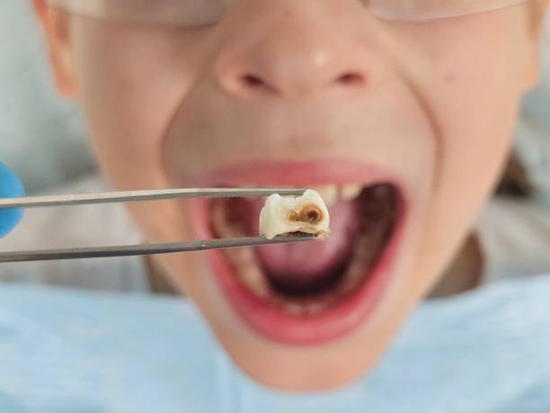 Best Emergency Wisdom Tooth Extraction in Roanoke, VA